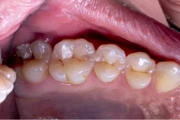 Treated Successfully